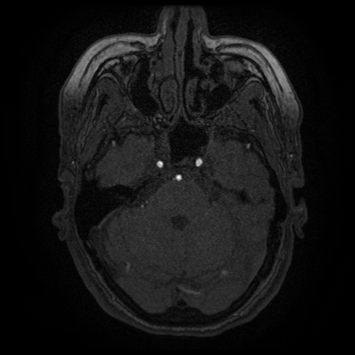 Cerebral venous infarction (Radiopaedia 25109-25363 MRA 19).jpg