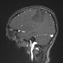 Cerebral venous infarction - hemorrhagic (Radiopaedia 81625-95505 Sagittal MRV 23).jpg