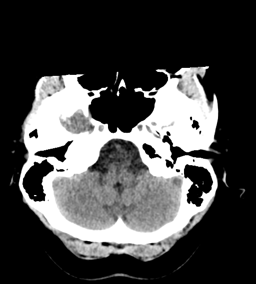 File:Cerebral venous infarction due to transverse sinus thrombosis (Radiopaedia 34688-36116 Axial non-contrast 5).png