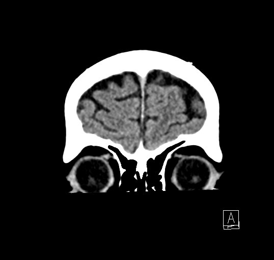 Cerebral venous infarction with hemorrhage (Radiopaedia 65343-74381 Coronal non-contrast 4).jpg