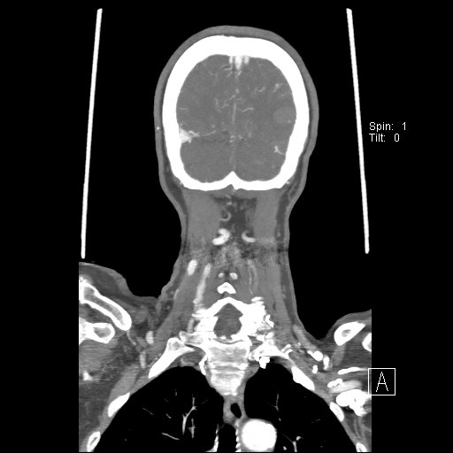 Cerebral venous infarction with hemorrhage (Radiopaedia 65343-74396 B 233).jpg