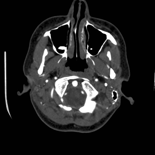 Cerebral venous sinus thrombosis (Radiopaedia 40619-43227 A 18).jpg