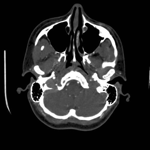 Cerebral venous sinus thrombosis (Radiopaedia 40619-43227 A 35).jpg