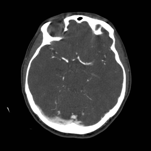 Cerebral venous sinus thrombosis (Radiopaedia 40619-43227 A 91).jpg