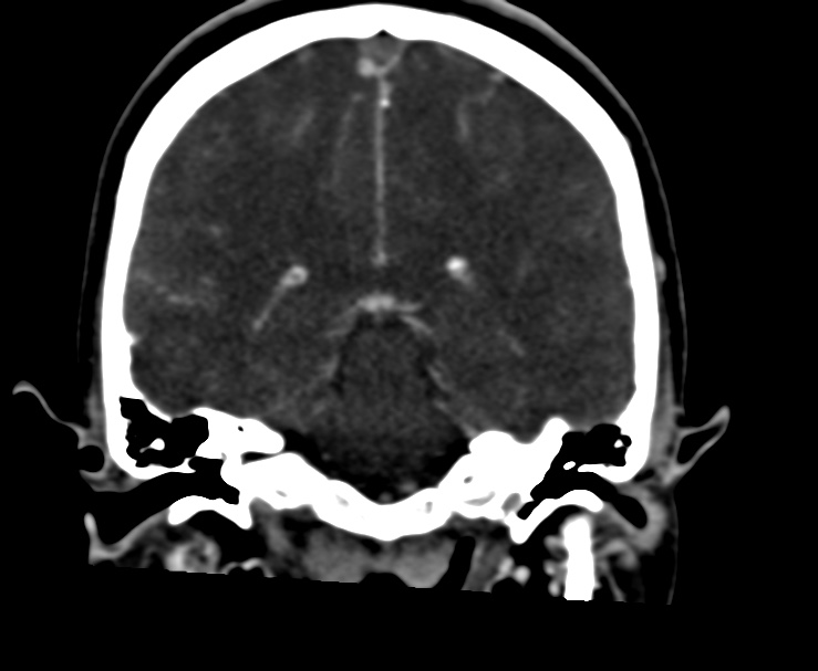 Cerebral venous sinus thrombosis (Radiopaedia 59224-66646 Coronal C+ delayed 47).jpg