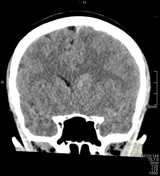 File:Cerebral venous sinus thrombosis (Radiopaedia 91329-108965 Coronal non-contrast 21).jpg