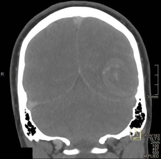 Cerebral venous sinus thrombosis (Radiopaedia 91329-108965 Coronal venogram 66).jpg