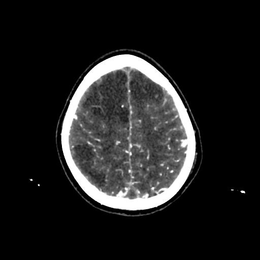 File:Cerebral venous throbmosis - hemorrhagic venous infarction (Radiopaedia 87318-103613 Axial CT venogram 31).jpg