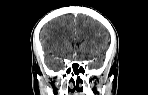 File:Cerebral venous thrombosis (CVT) (Radiopaedia 77524-89685 C 22).jpg