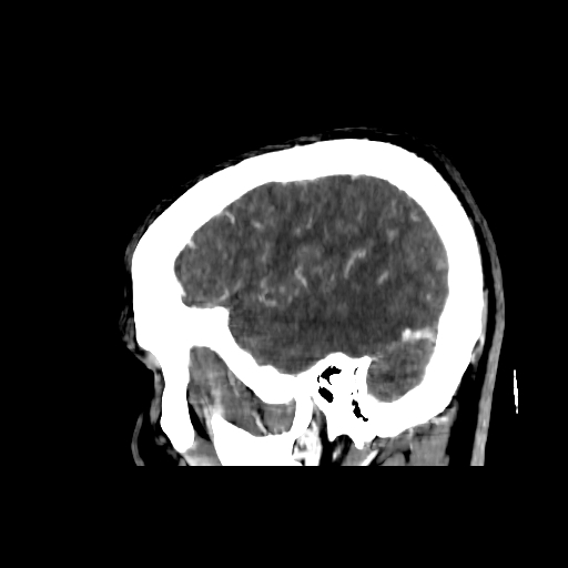 File:Cerebral venous thrombosis (CVT) (Radiopaedia 77524-89685 Sagittal CTV 40).jpg