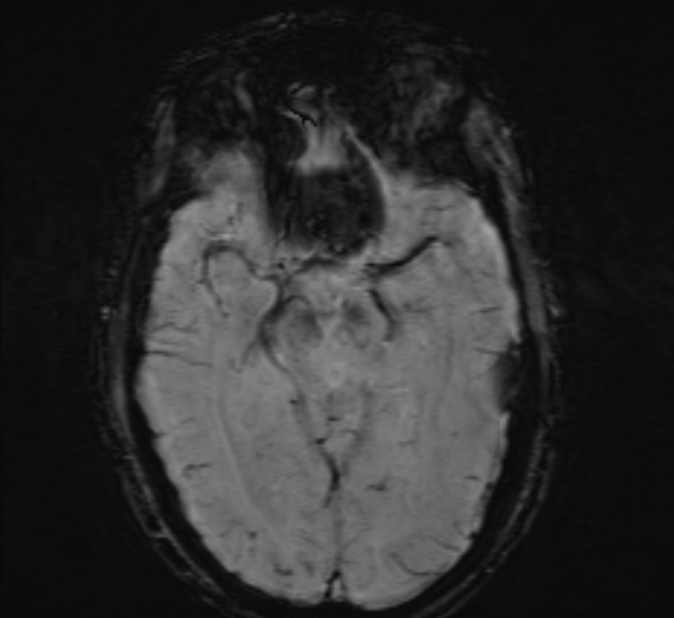Cerebral venous thrombosis (Radiopaedia 71207-81504 Axial SWI 21).jpg