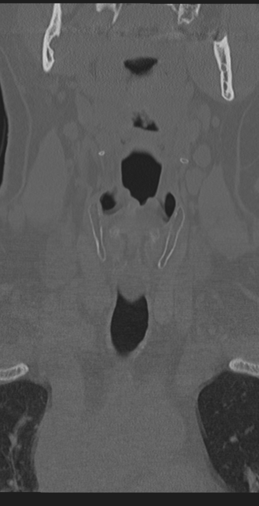 Cervical canal stenosis due to ossification of the posterior longitudinal ligament (Radiopaedia 47260-51823 Coronal bone window 2).png