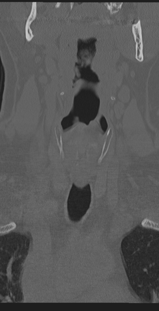 Cervical canal stenosis due to ossification of the posterior longitudinal ligament (Radiopaedia 47260-51823 Coronal bone window 3).png