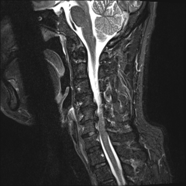 File:Cervical disc extrusion (Radiopaedia 53950-60077 Sagittal STIR 11).jpg
