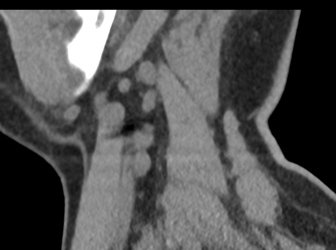 File:Cervical disc replacement (Radiopaedia 44025-47541 B 18).png