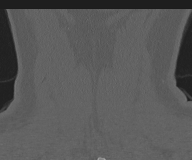 Cervical disc replacement (Radiopaedia 44025-47541 Coronal bone window 49).png