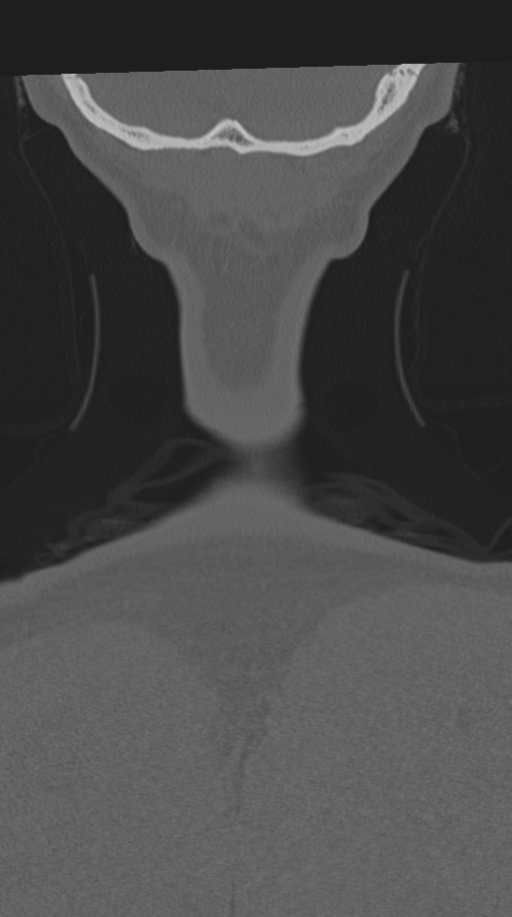 Cervical intercalary bone (Radiopaedia 35211-36748 Coronal bone window 83).png