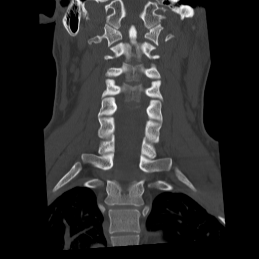 Cervical schwannoma (Radiopaedia 57979-64974 Coronal bone window 31).png