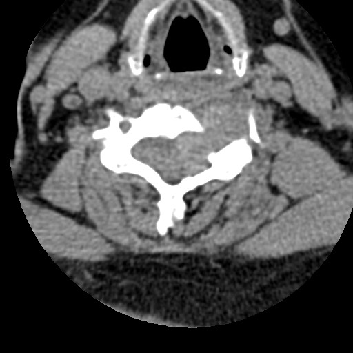 File:Cervical spinal neurofibroma in a patient with NF1 (Radiopaedia 58344-65464 Axial non-contrast 47).jpg