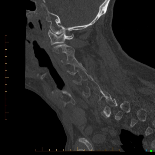 File:Cervical spine fracture - ankylosing spondylitis (Radiopaedia 76835-88706 Sagittal bone window 78).jpg