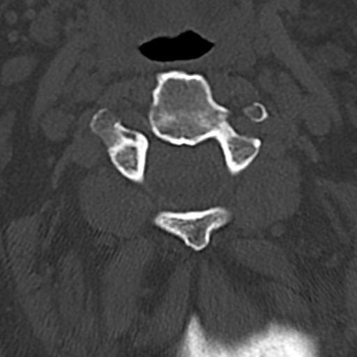 File:Cervical spine fracture - chalk stick (Radiopaedia 39116-41323 Axial bone window 24).png