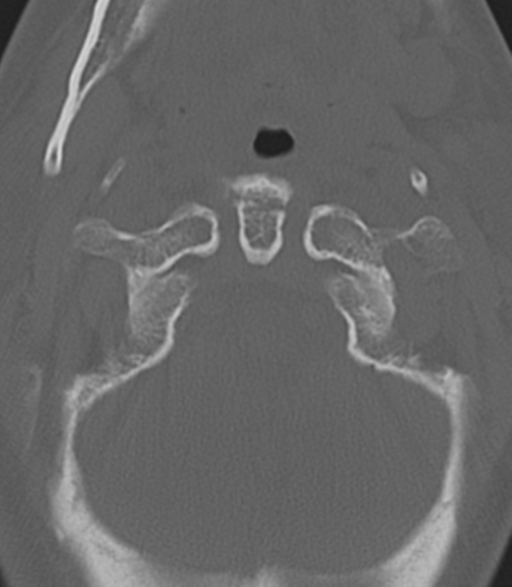 Cervical spine fractures with vertebral artery dissection (Radiopaedia 53296-59268 Axial bone window 12).png