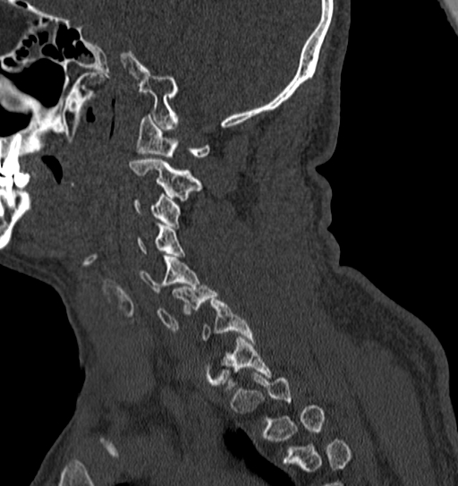 Cervical spine trauma with tear drop fracture and perched facet joint (Radiopaedia 53989-60127 Sagittal bone window 121).jpg