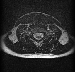 File:Cervical spondylodiscitis and calvarial hemangioma (Radiopaedia 64317-73104 Axial T2 18).jpg