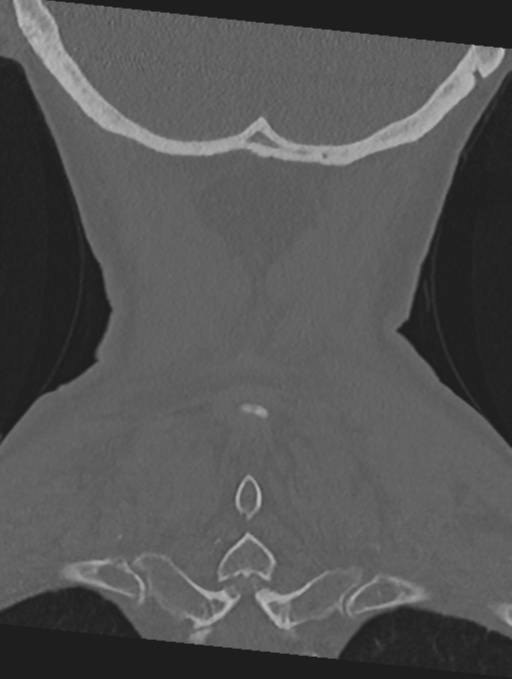Cervical spondylolysis (Radiopaedia 49616-54811 Coronal bone window 54).png