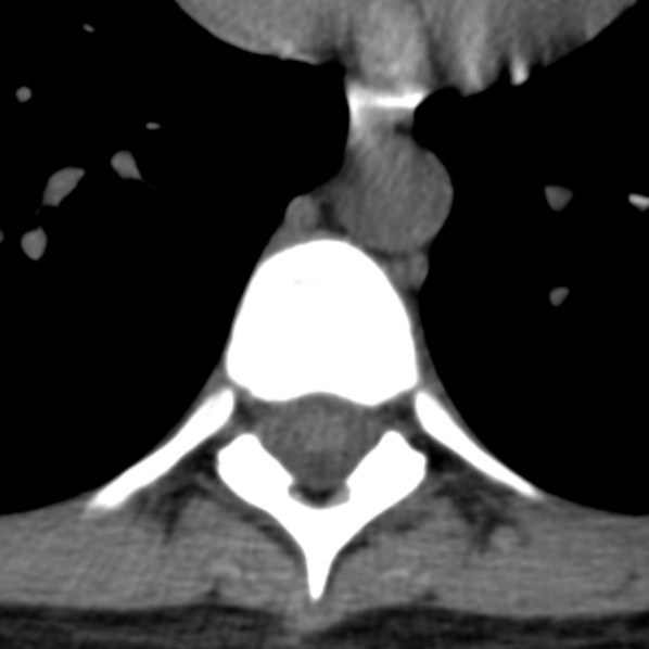 File:Chance fracture (Radiopaedia 36521-38081 Axial non-contrast 23).jpg