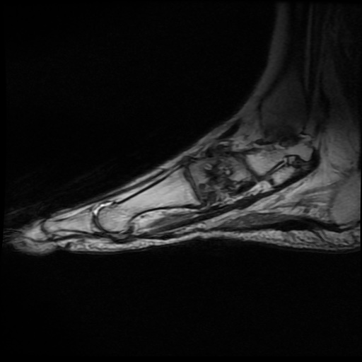 File:Charcot arthropathy (Radiopaedia 55056-61422 Sagittal T1 in-phase 6).jpg