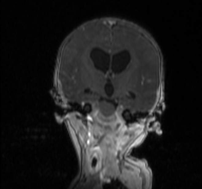 Chiari III malformation with occipital encephalocele (Radiopaedia 79446-92559 Coronal T1 C+ mpr 15).jpg