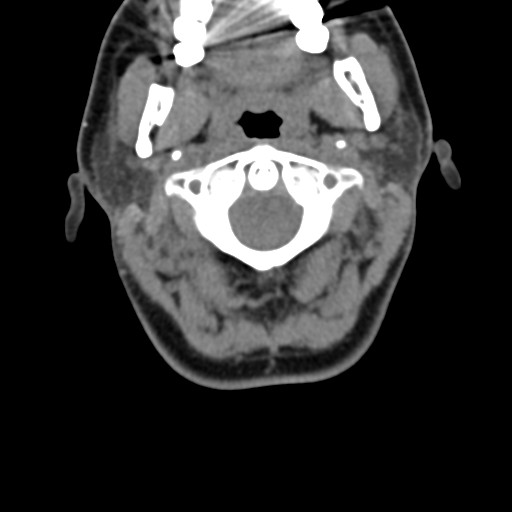 Chiari I malformation and obstructive hydrocephalus (Radiopaedia 41185-43981 D 35).png