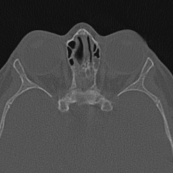Choanal atresia (Radiopaedia 88525-105975 Axial bone window 92).jpg