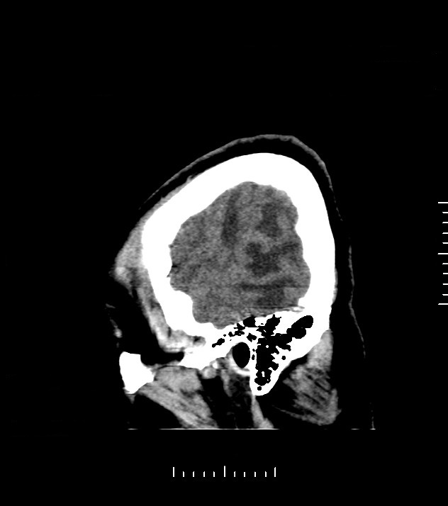 Cholangiocarcinoma with cerebral metastases (Radiopaedia 83519-98628 C 4).jpg