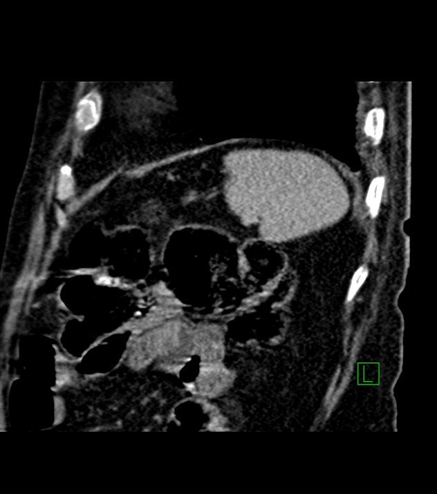 Cholangiocarcinoma with cerebral metastases (Radiopaedia 83519-98629 Sagittal C+ delayed 22).jpg
