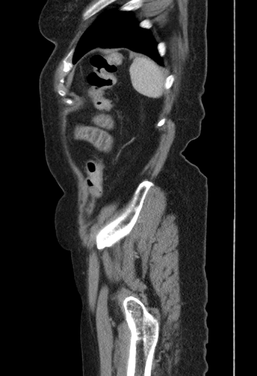 Cholecystoduodenal fistula due to calculous cholecystitis with gallstone migration (Radiopaedia 86875-103077 F 5).jpg