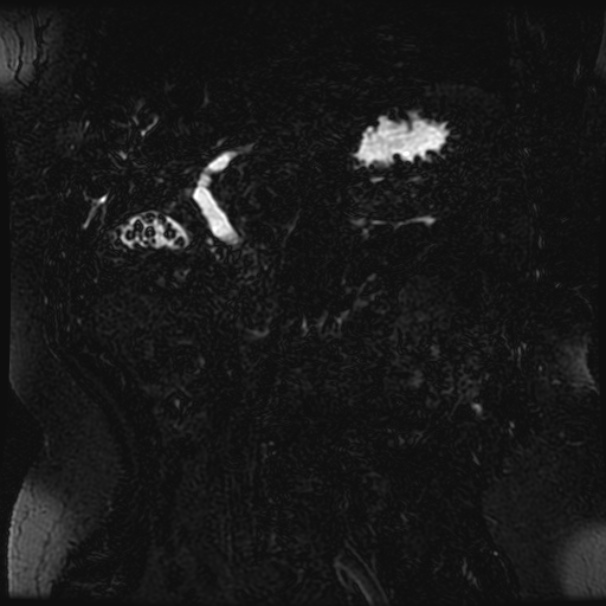 Choledocholithiasis on CT and MRI (Radiopaedia 24825-25088 Coronal T2 43).jpg