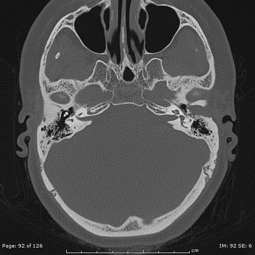 Cholesteatoma - external auditory canal (Radiopaedia 88452-105096 Axial bone window 55).jpg