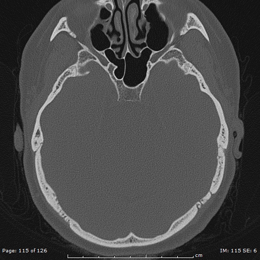 Cholesteatoma - external auditory canal (Radiopaedia 88452-105096 Axial bone window 78).jpg
