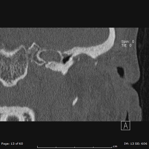 Cholesteatoma - external auditory canal (Radiopaedia 88452-105096 Coronal bone window 13).jpg