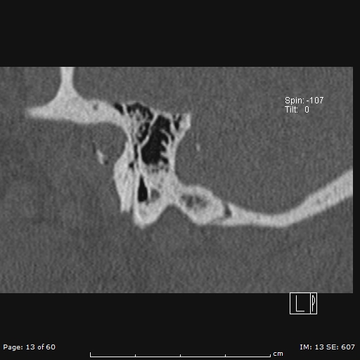 Cholesteatoma - external auditory canal (Radiopaedia 88452-105096 Sagittal bone window 13).jpg