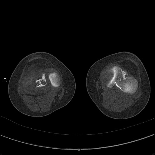 Chondroblastoma (Radiopaedia 62721-71030 Axial bone window 39).jpg