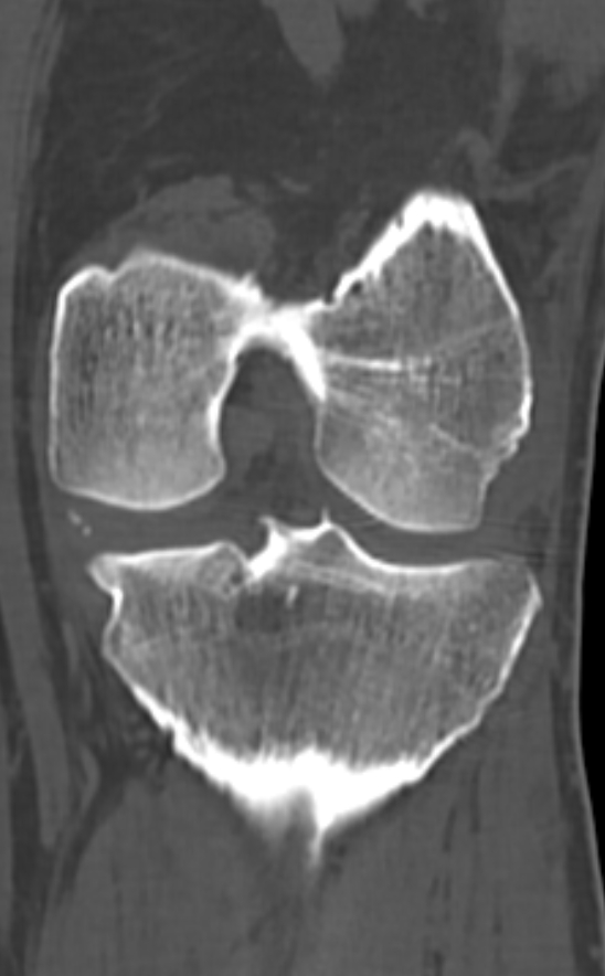 Chondrocalcinosis (Radiopaedia 82862-97173 Coronal bone window 51).jpg