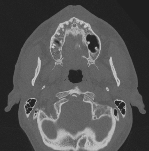 Chondrosarcoma (clivus) (Radiopaedia 46895-51425 Axial bone window 76).png