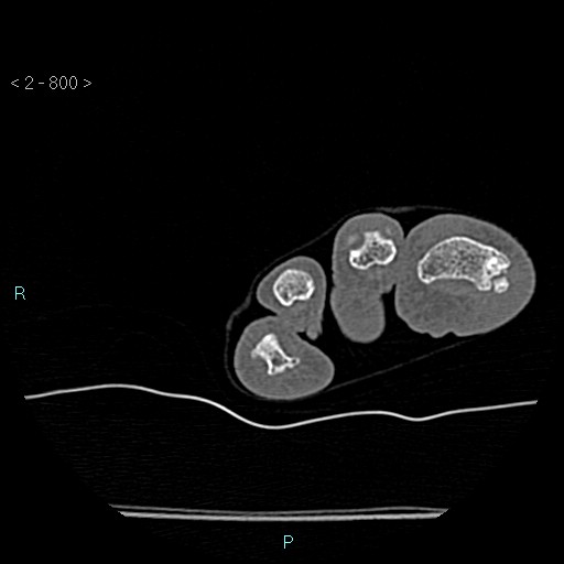 Chondrosarcoma - phalanx (Radiopaedia 69047-78812 Axial bone window 54).jpg
