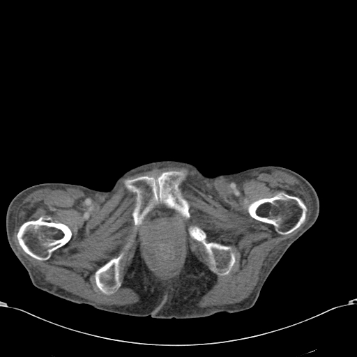Chondrosarcoma of the spine (Radiopaedia 49871-55143 A 66).jpg