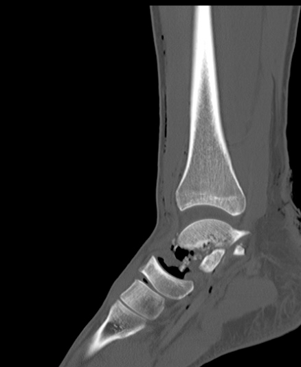 Chopart fracture (Radiopaedia 35347-36851 Sagittal bone window 34).jpg