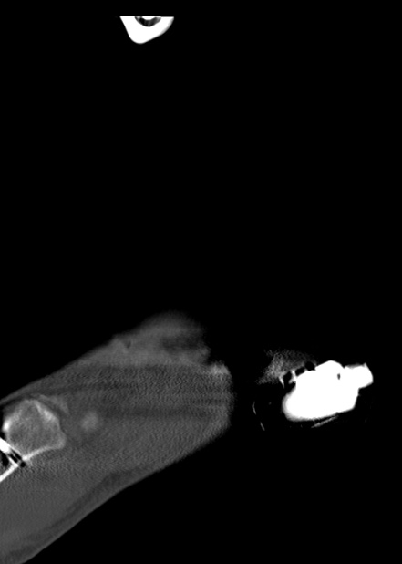 Chopart fracture (Radiopaedia 35347-36861 Sagittal bone window 23).jpg
