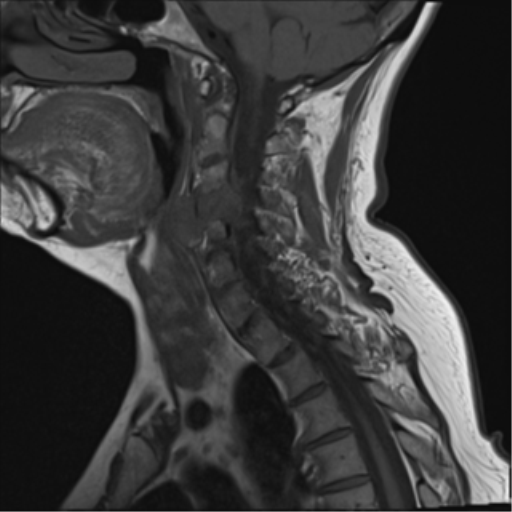File:Chordoma (C4 vertebra) (Radiopaedia 47561-52189 Sagittal T1 9).png